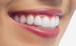On parle de tout - Mal a l'aise avec votre appareil dentaire voyant  Découvrez Invisalign (2)