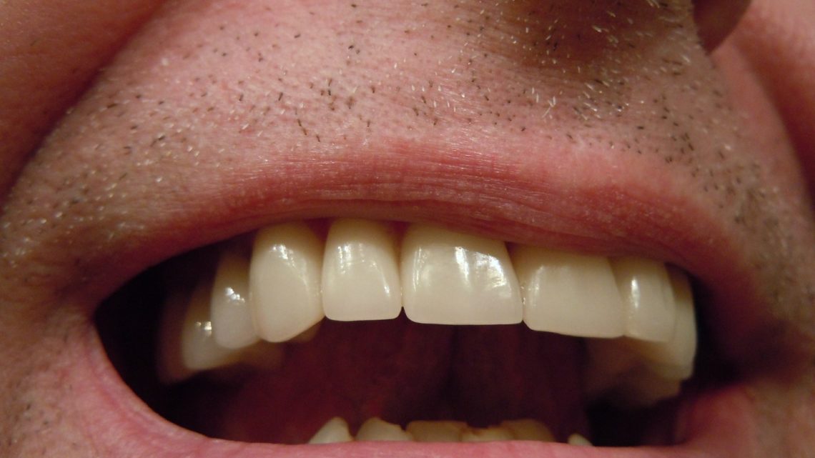 Tout savoir sur les implants dentaires